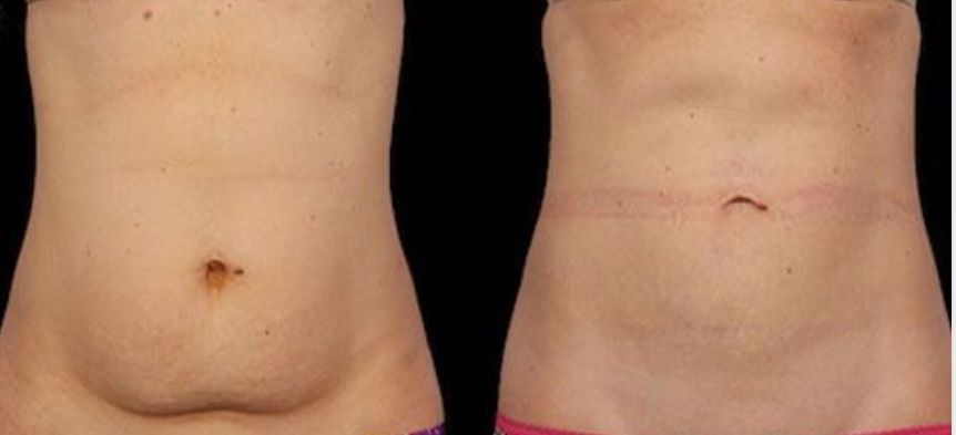Body Contouring before & after